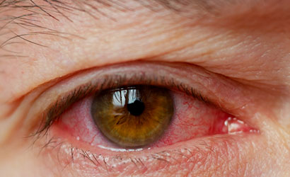 Glaucoma Treatment