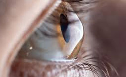 Keratoconus Treatment