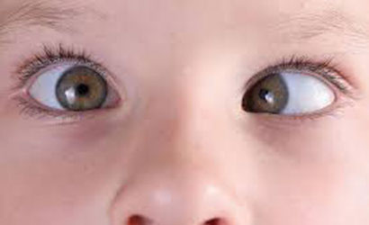 Squint Treatment